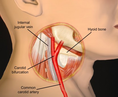 pressure on carotid artery