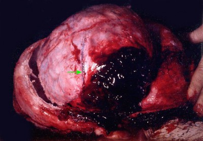 epidural hematoma gross