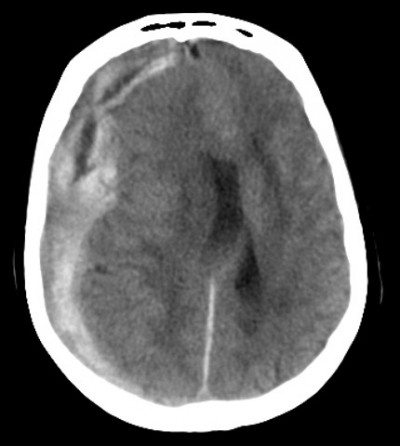 meningeal haemorrhage :: www.forensicmed.co.uk